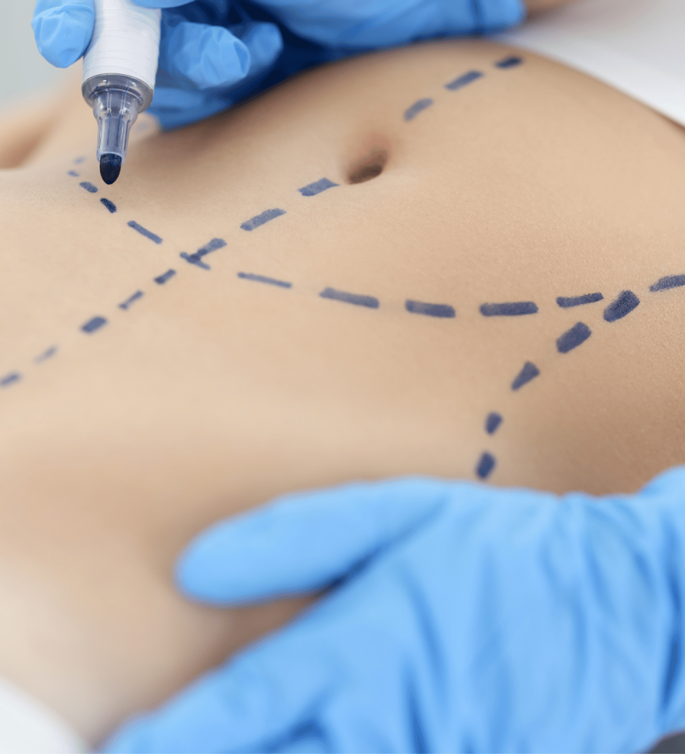abdominoplastia-brasilia-cirurgia-plastica-df-clinica-fleury-centro-integrado
